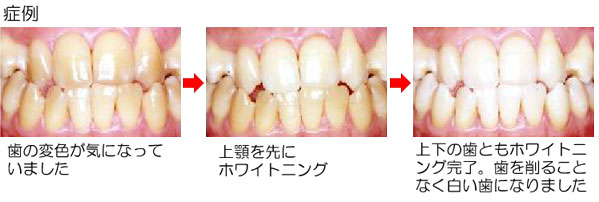 ホワイトニング